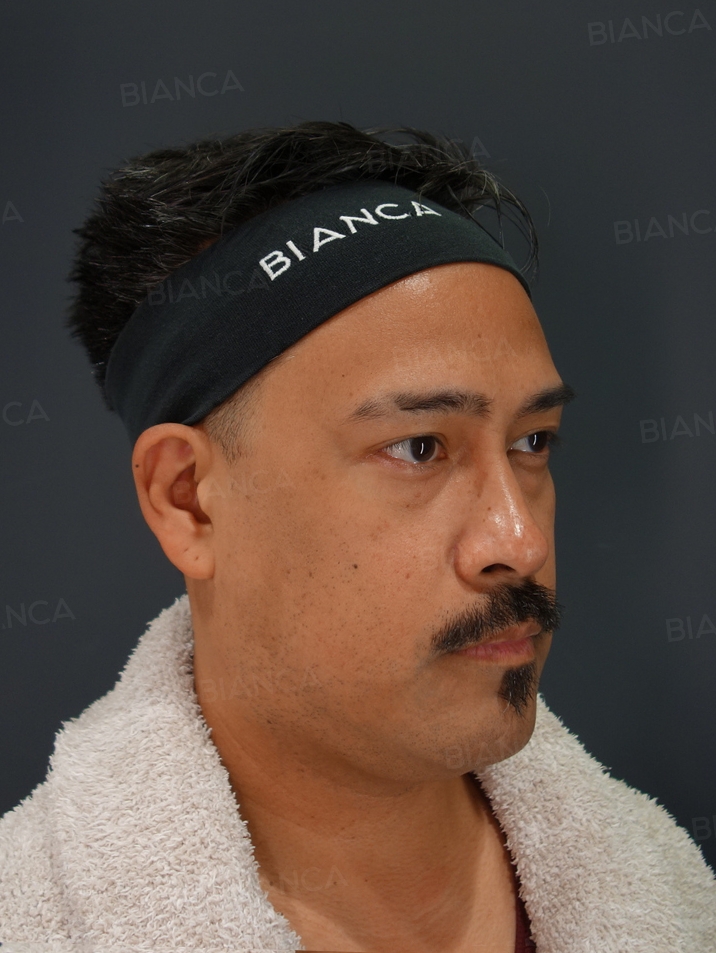 45-degree View Before