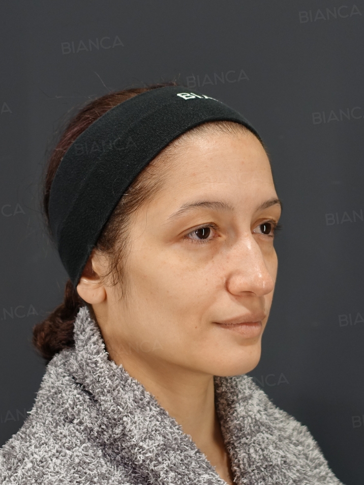 45-degree View Before