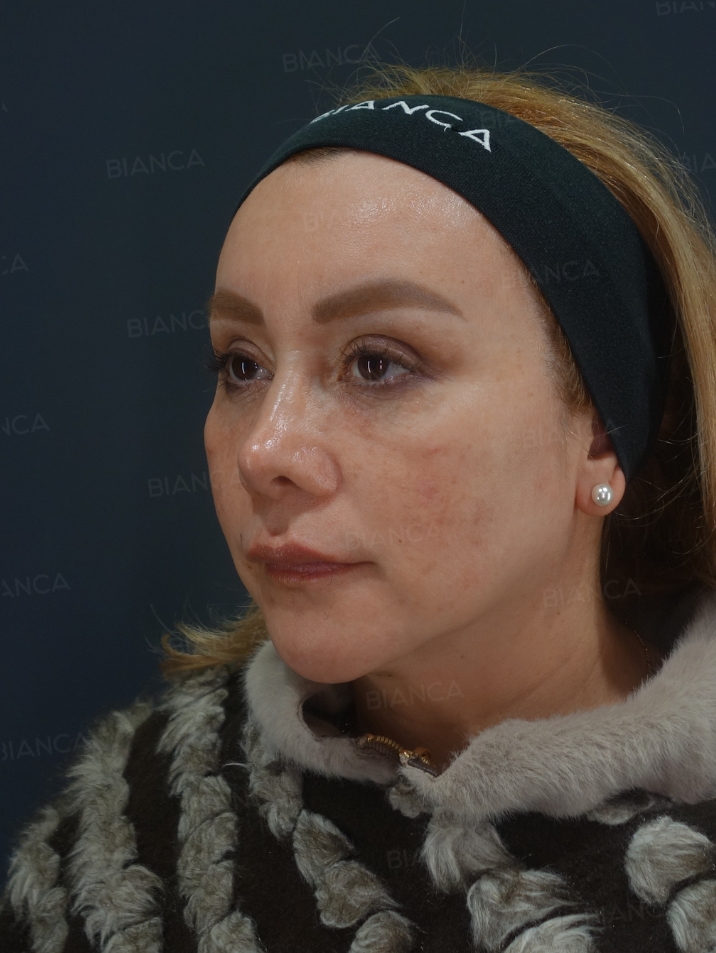 45-degree View After