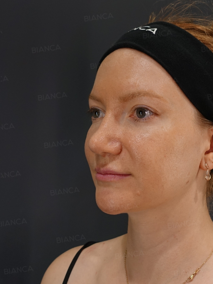 45-degree View After