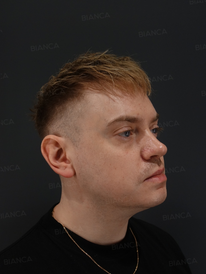 45-degree View Before