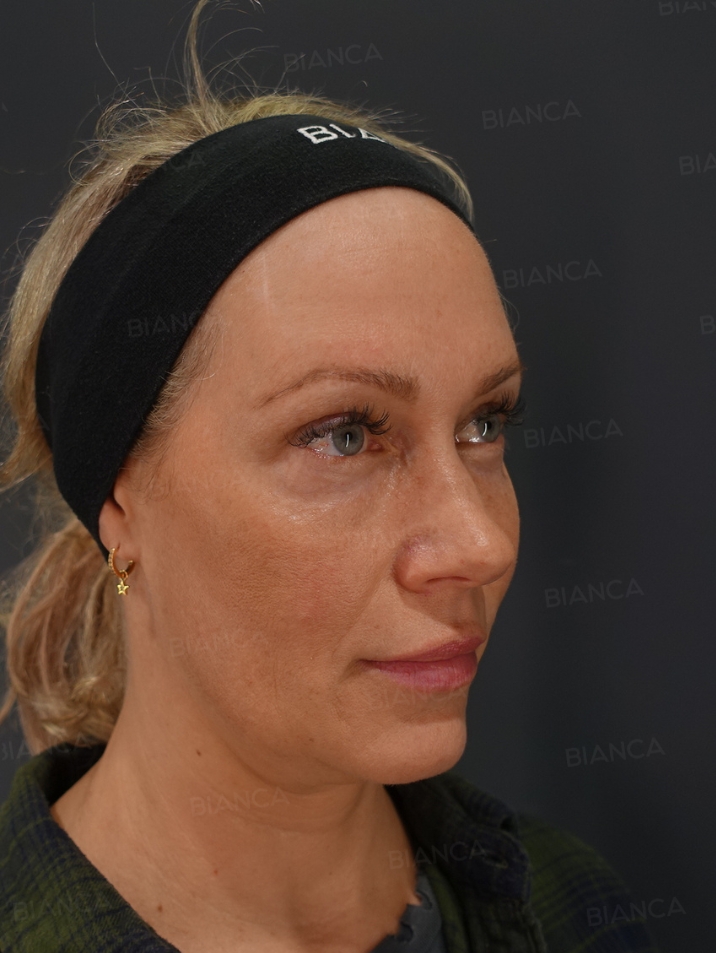 45-degree View After