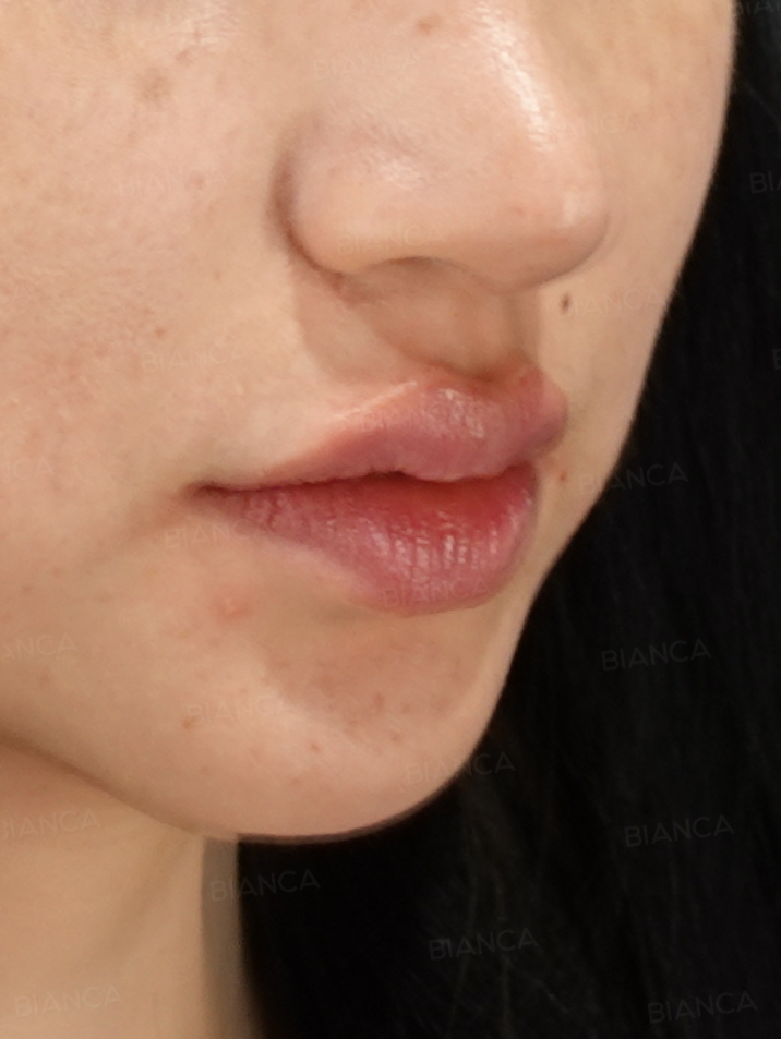 45-degree View After