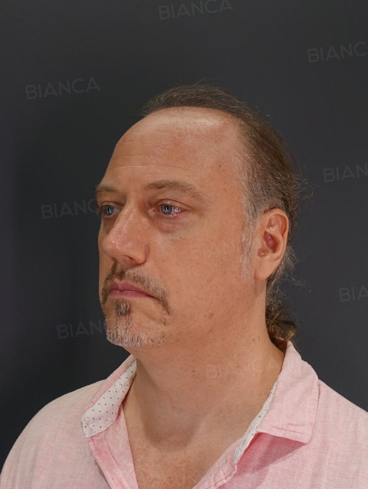 45-degree View After