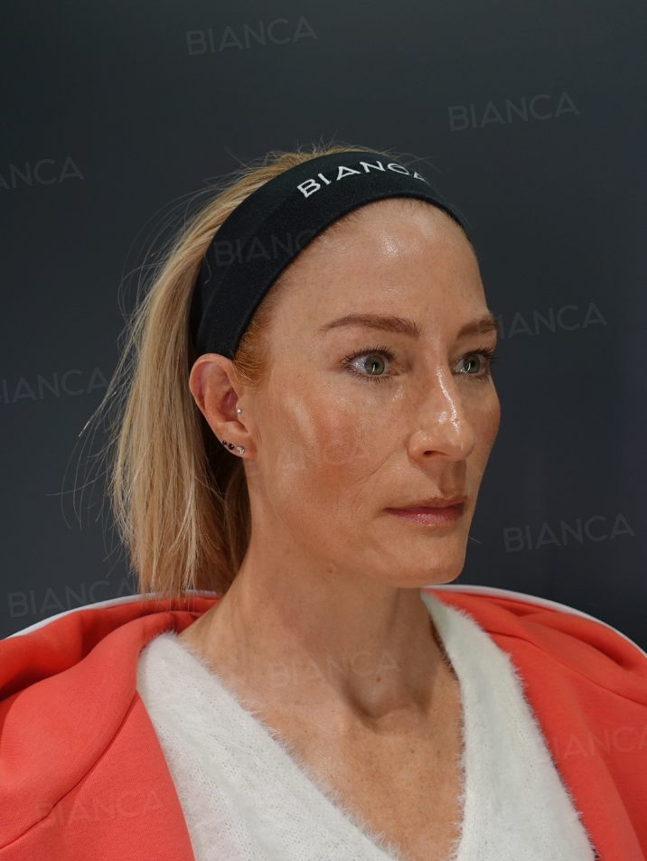 45-degree View After