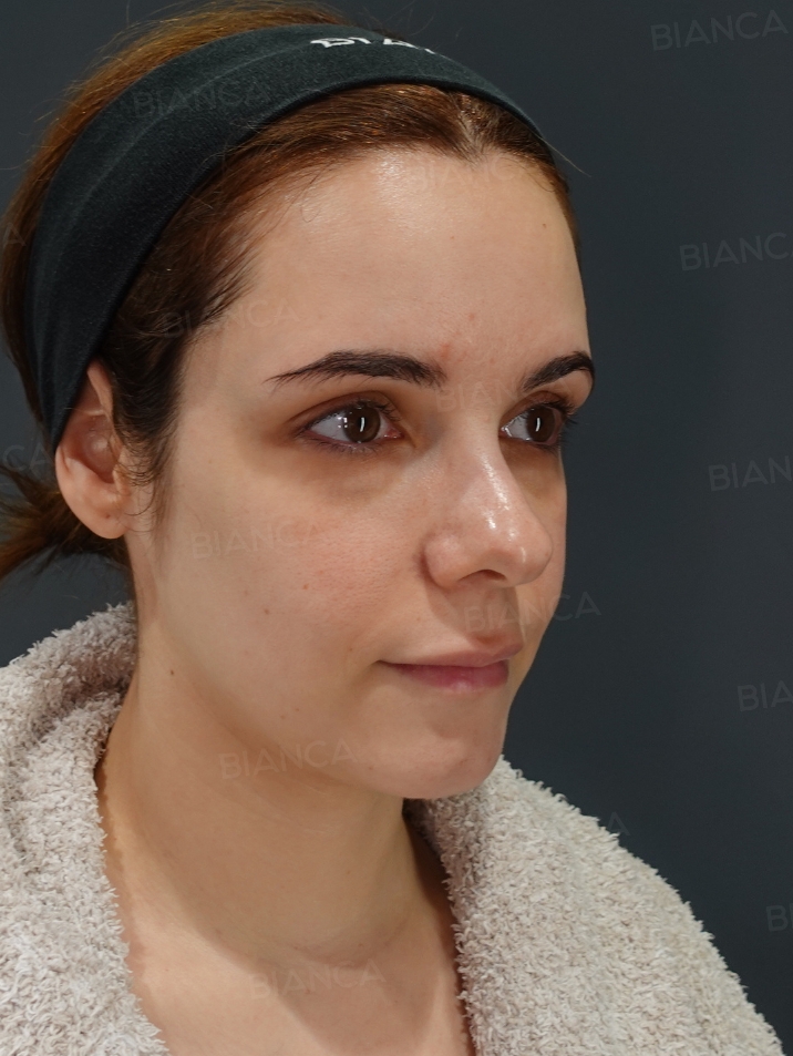 45-degree View Before