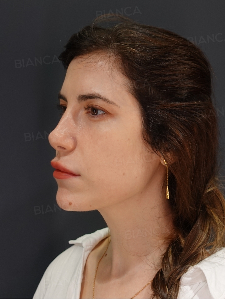 45-degree View After