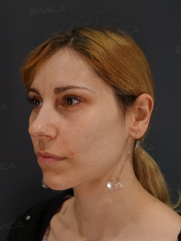 45-degree View Before