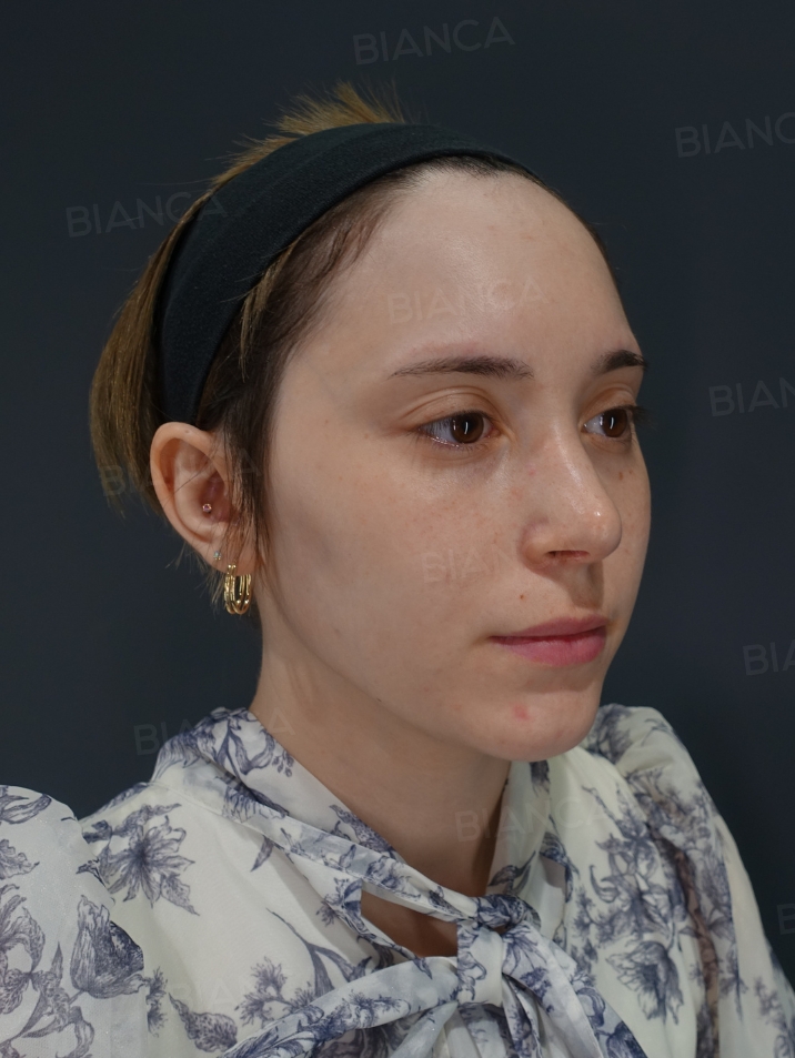 45-degree View After