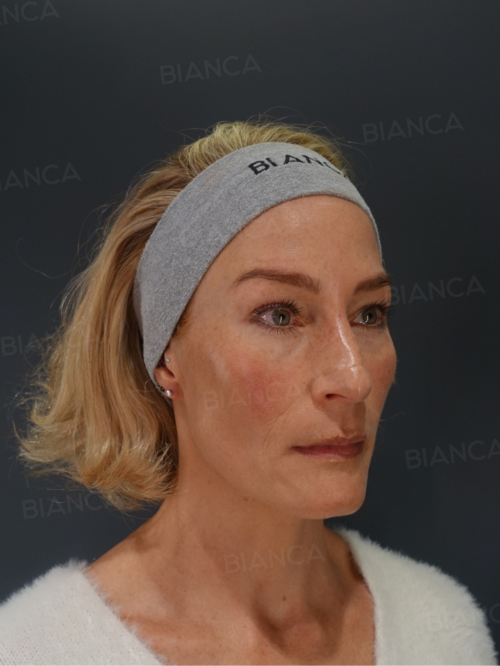 45-degree View Before