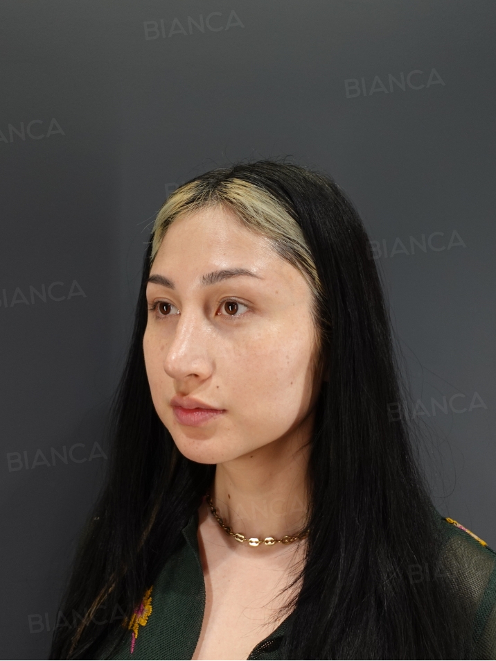 45-degree View Before