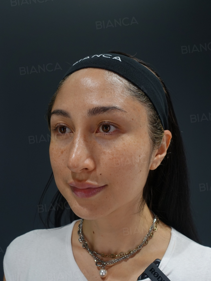 45-degree View Before