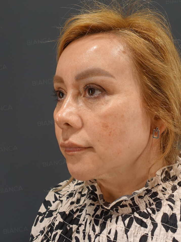 45-degree View Before