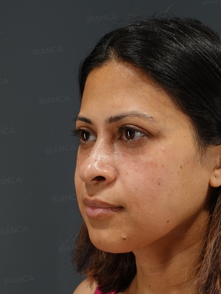 45-degree View After