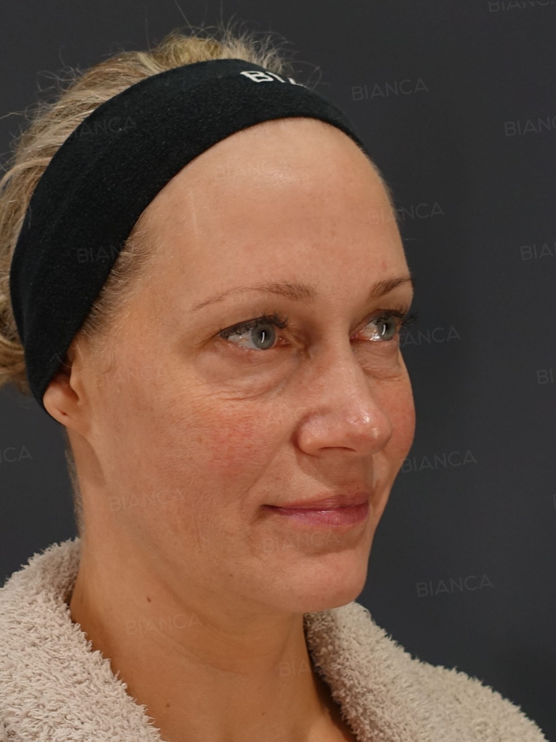 45-degree View Before