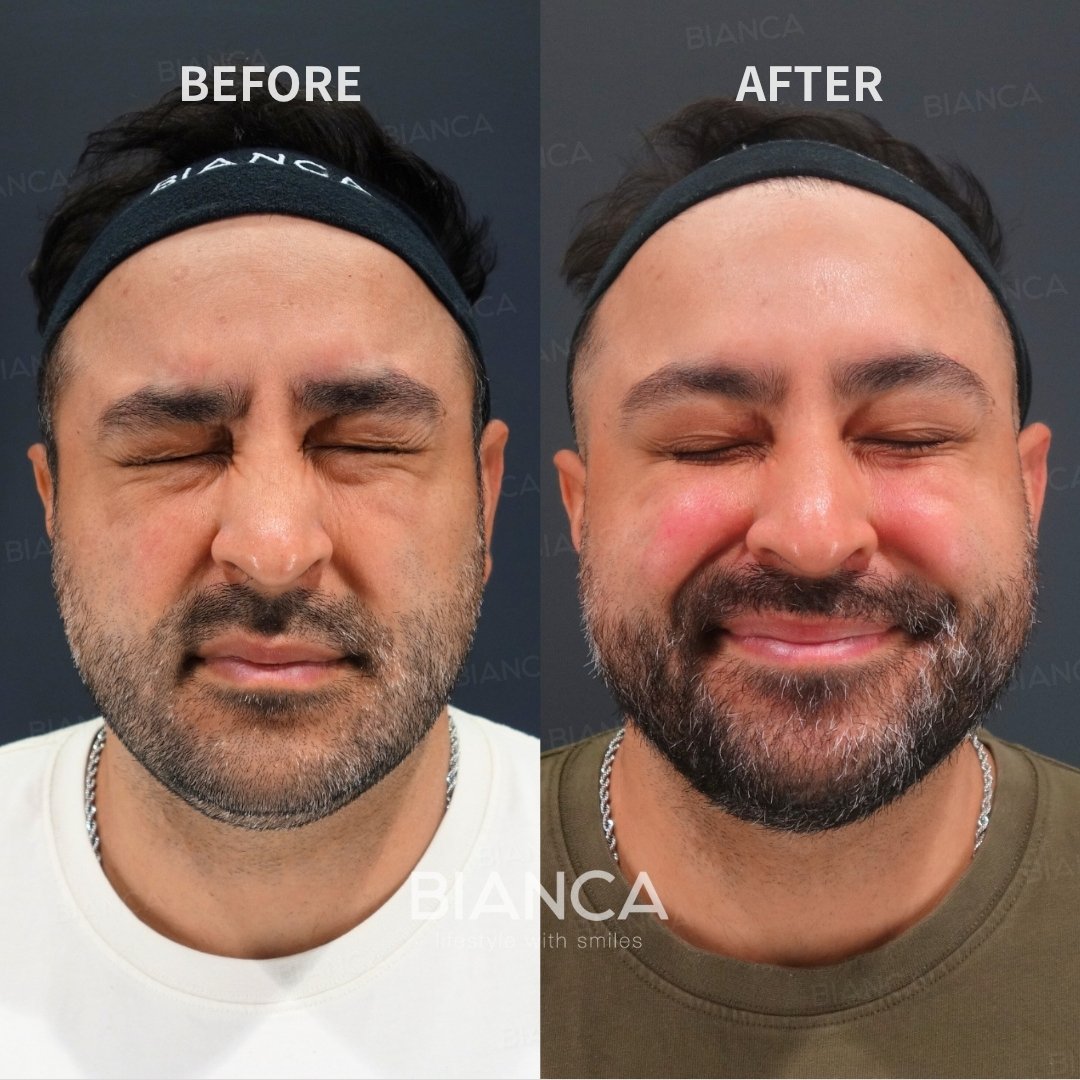 Botox Treatment Forehead Botox / Crow’s Feet Botox (Allergan Botox)