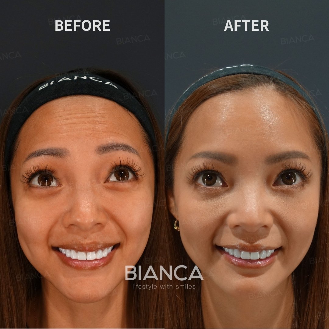 Botox Treatment  Forehead Botox (Allergan Botox)
