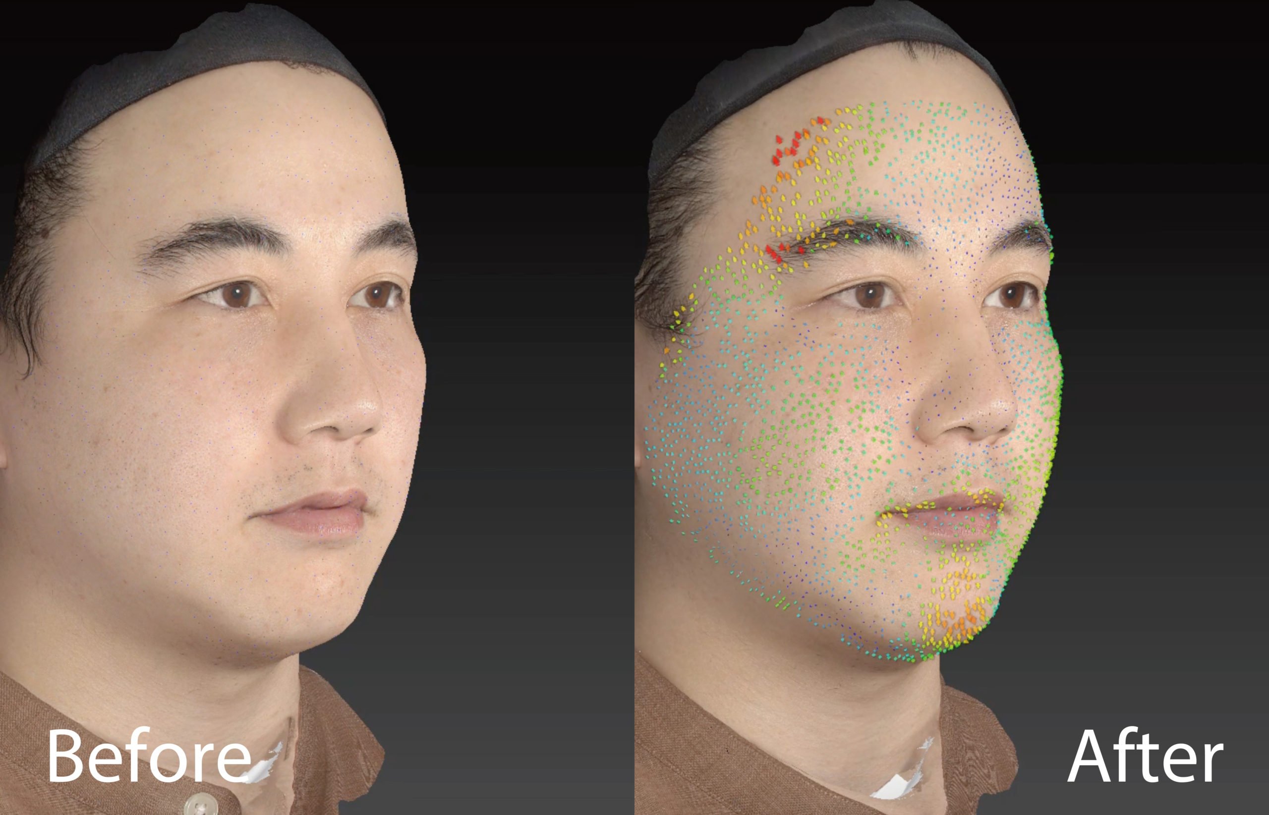 Party Lift (SMAS-up Neo) : Instant Lifting with Next-Generation RF Technology