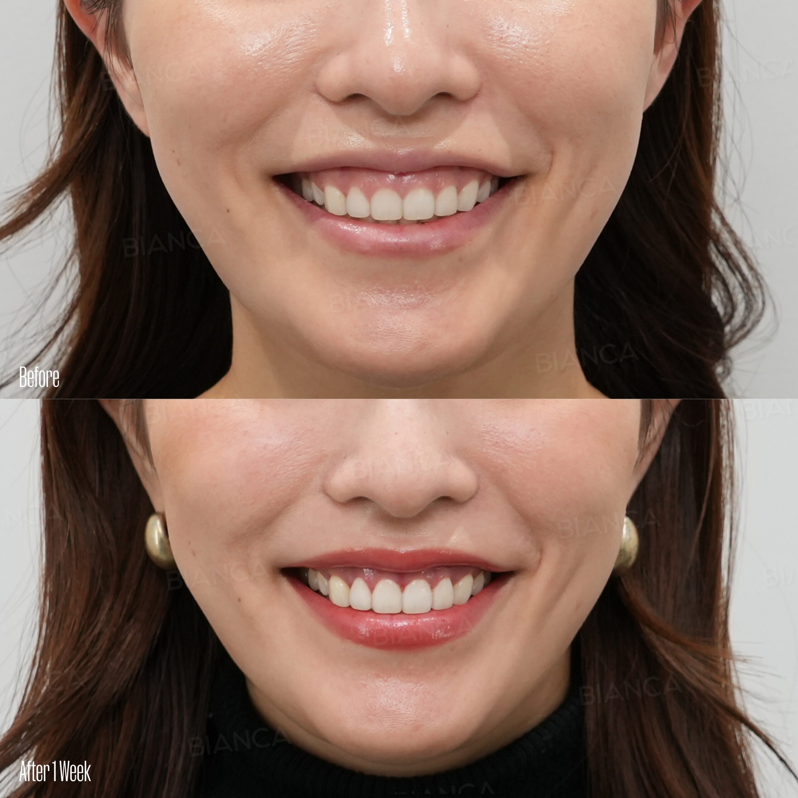 Cosmetic Surgery Celebrity Treatment in Tokyo