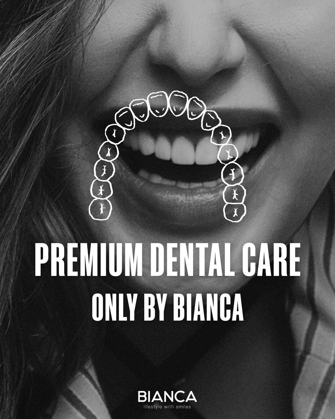 【New Treatment】Gummy Smile Treatment