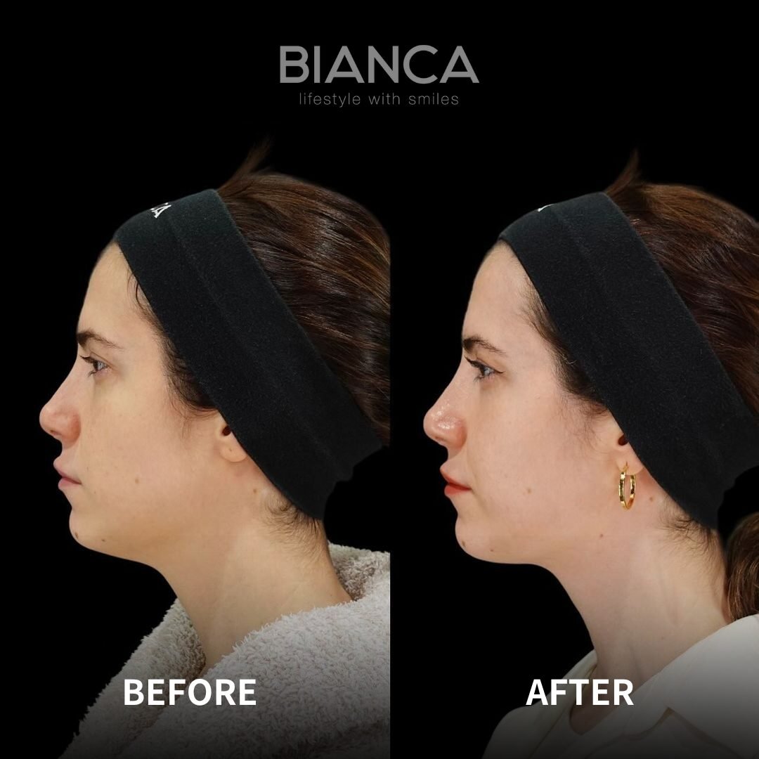 EmbraceRF: The Breakthrough in Jawline Redefinition – A Patient-Centered Guide to Cosmetic Surgery in Tokyo, Japan