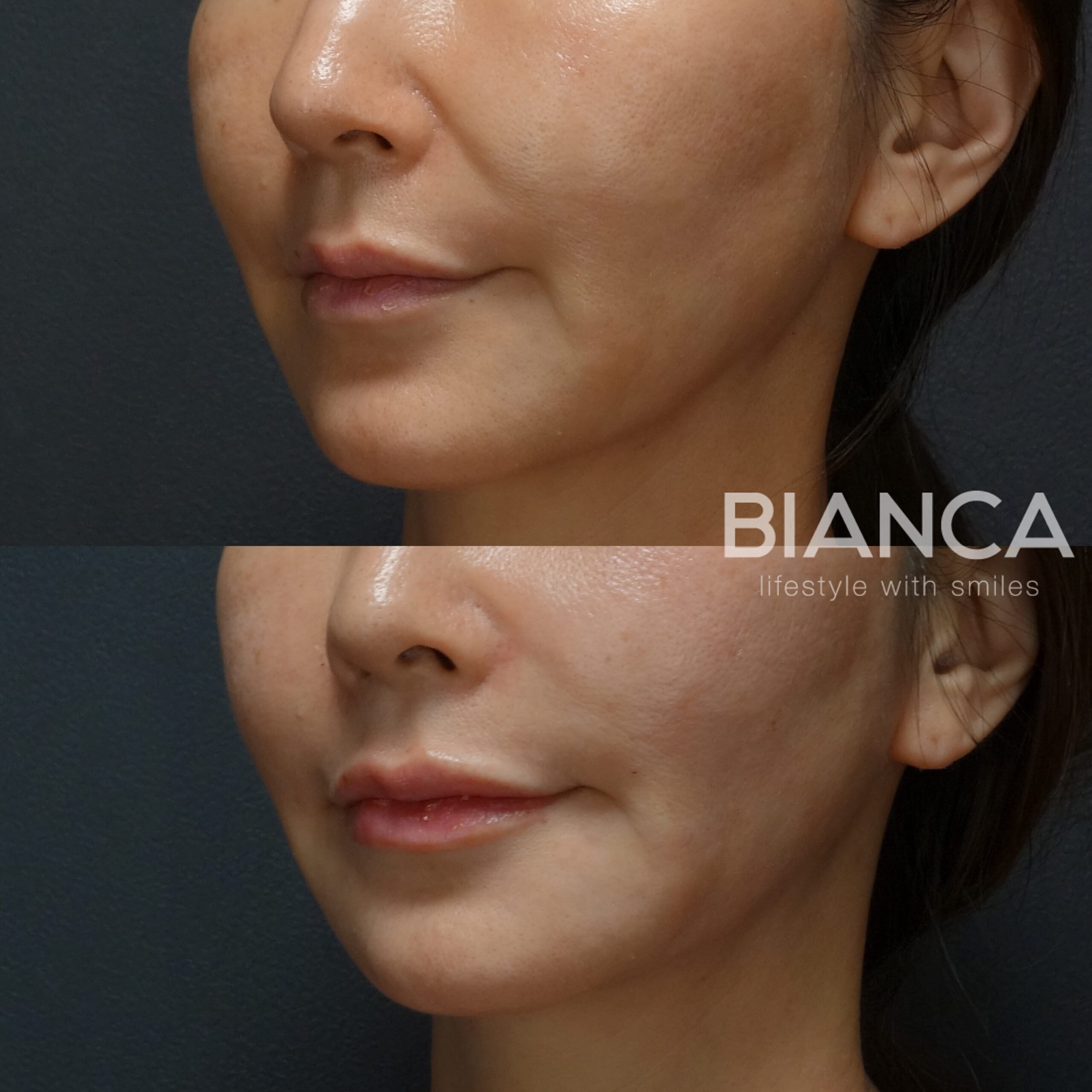 Fillers for Marionette Lines: Expert, Natural-Looking Care in Tokyo