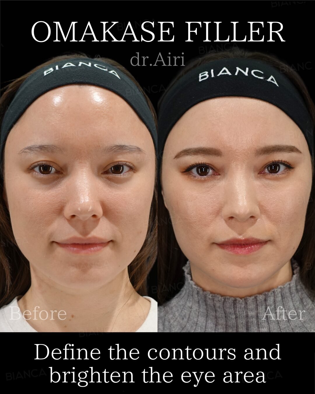 Botox Jaw Slimming in Tokyo: Expert Guide to a Softer, Balanced Face in Japan