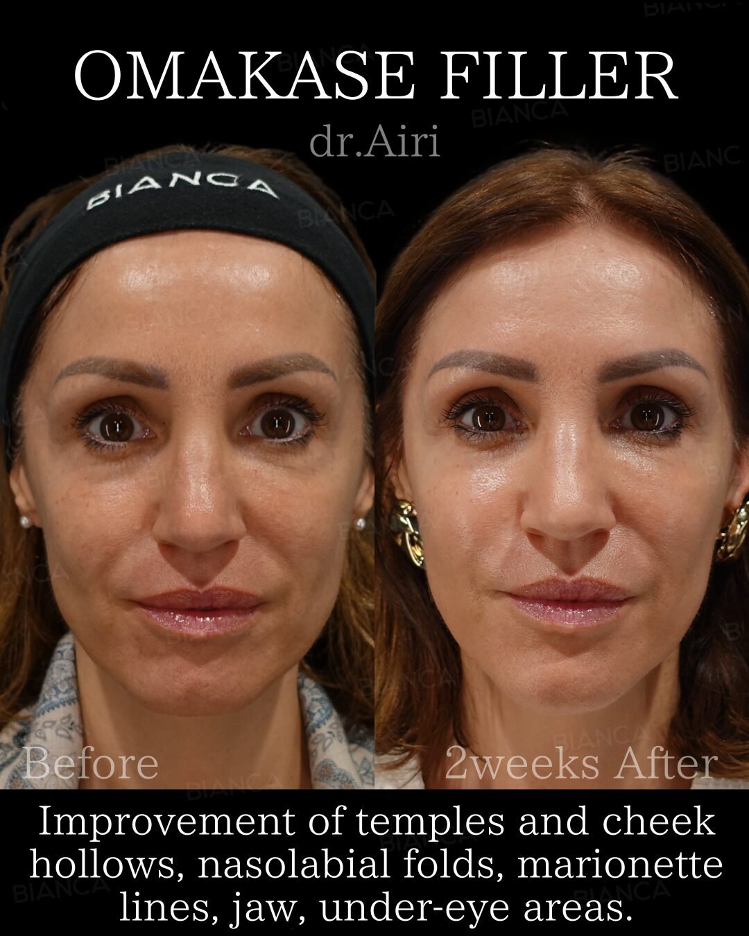 Fillers Under Eyes Cost: Your Patient‑Friendly Guide from Tokyo