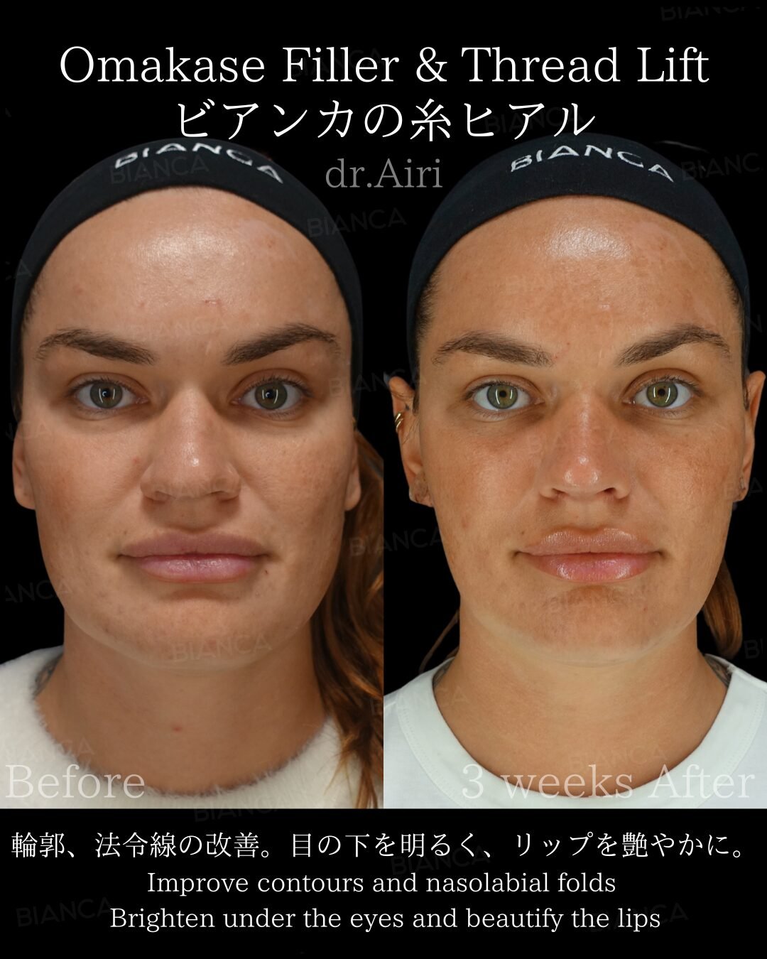 Fillers Juvederm Guide: Smooth, Natural Results in Tokyo