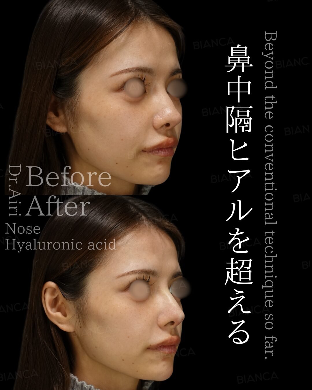 Nose Fillers Before & After: A Beginner’s Guide in Tokyo, in japan