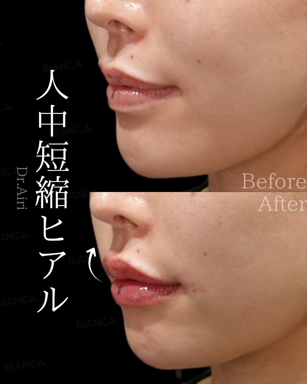 Lip Fillers Natural Look: Subtle, Balanced Results for International Clients in Tokyo