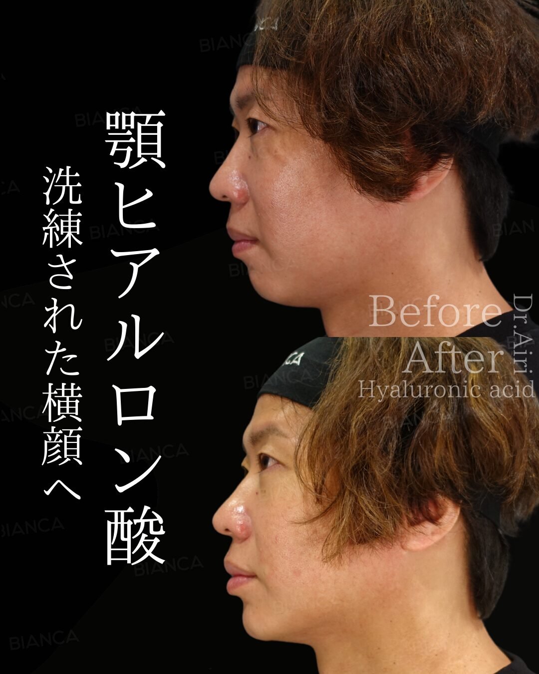 Fillers for your Chin: A Sleek E‑Line in Tokyo