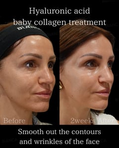 Hyaluronic acid × baby collagen