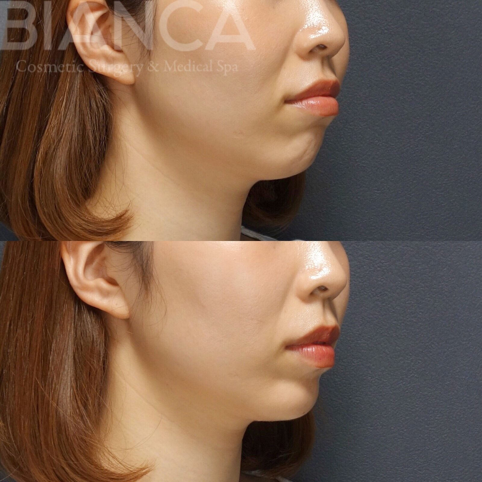Botox Face Guide: Expert, Natural Rejuvenation in Tokyo and in japan