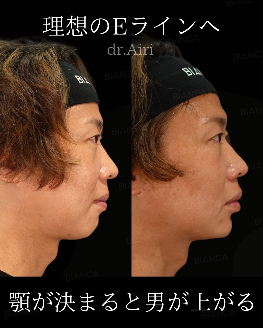 Natural Harmony with Fillers One Piece Treatment in Tokyo