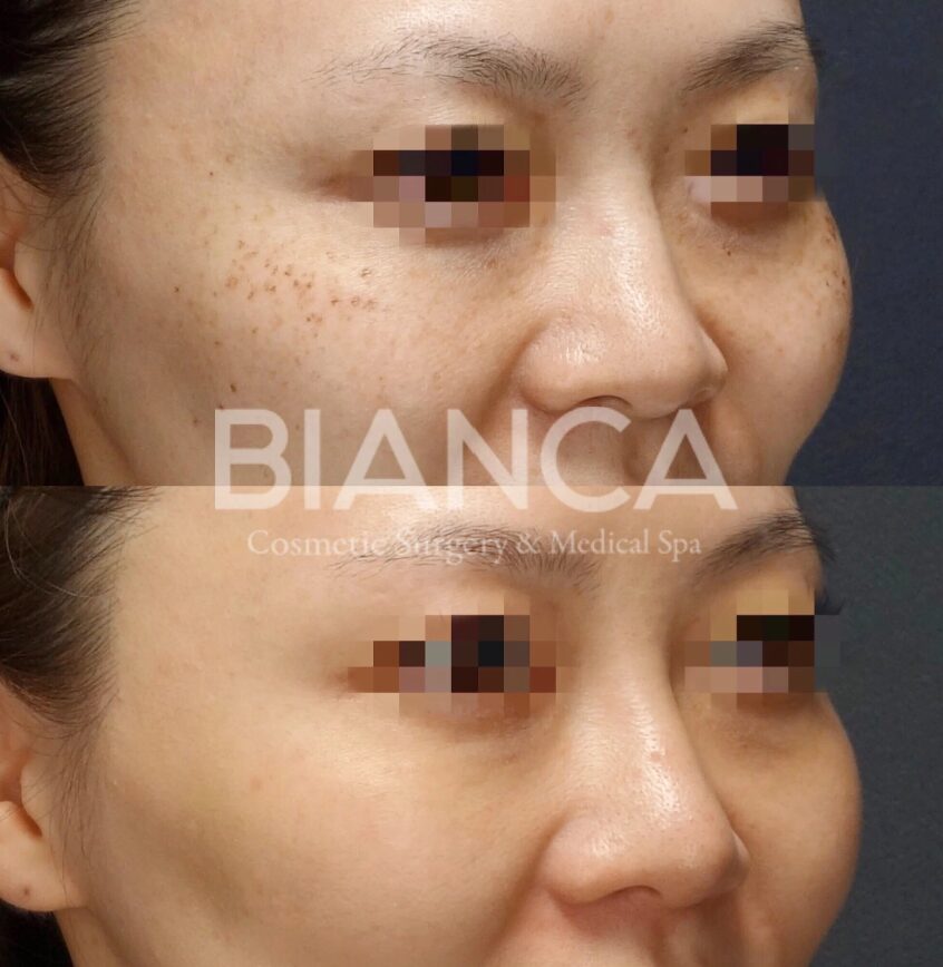 Laser Skin Treatment in Tokyo: A Guide to Choosing a Medical Spa Near Me