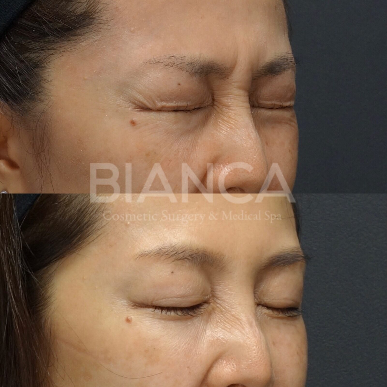 Botox Crows Feet in Tokyo: Safe, Natural Rejuvenation You Can Trust