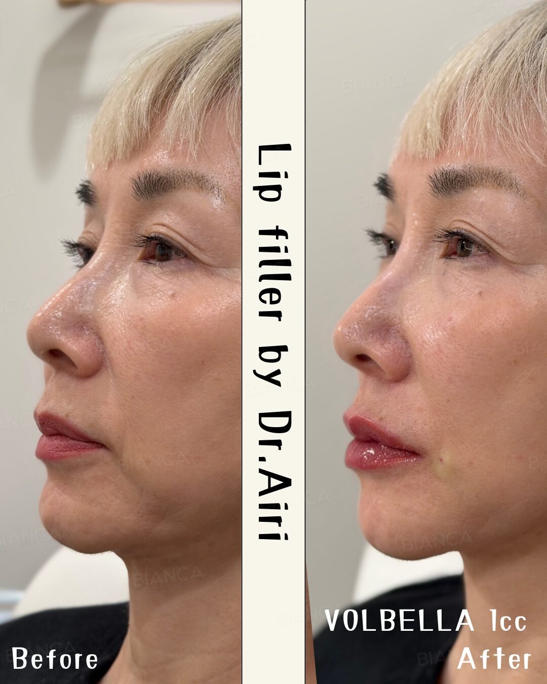 Hyaluronic Acid Fillers Explained: Safe, Natural Rejuvenation in Tokyo and in japan