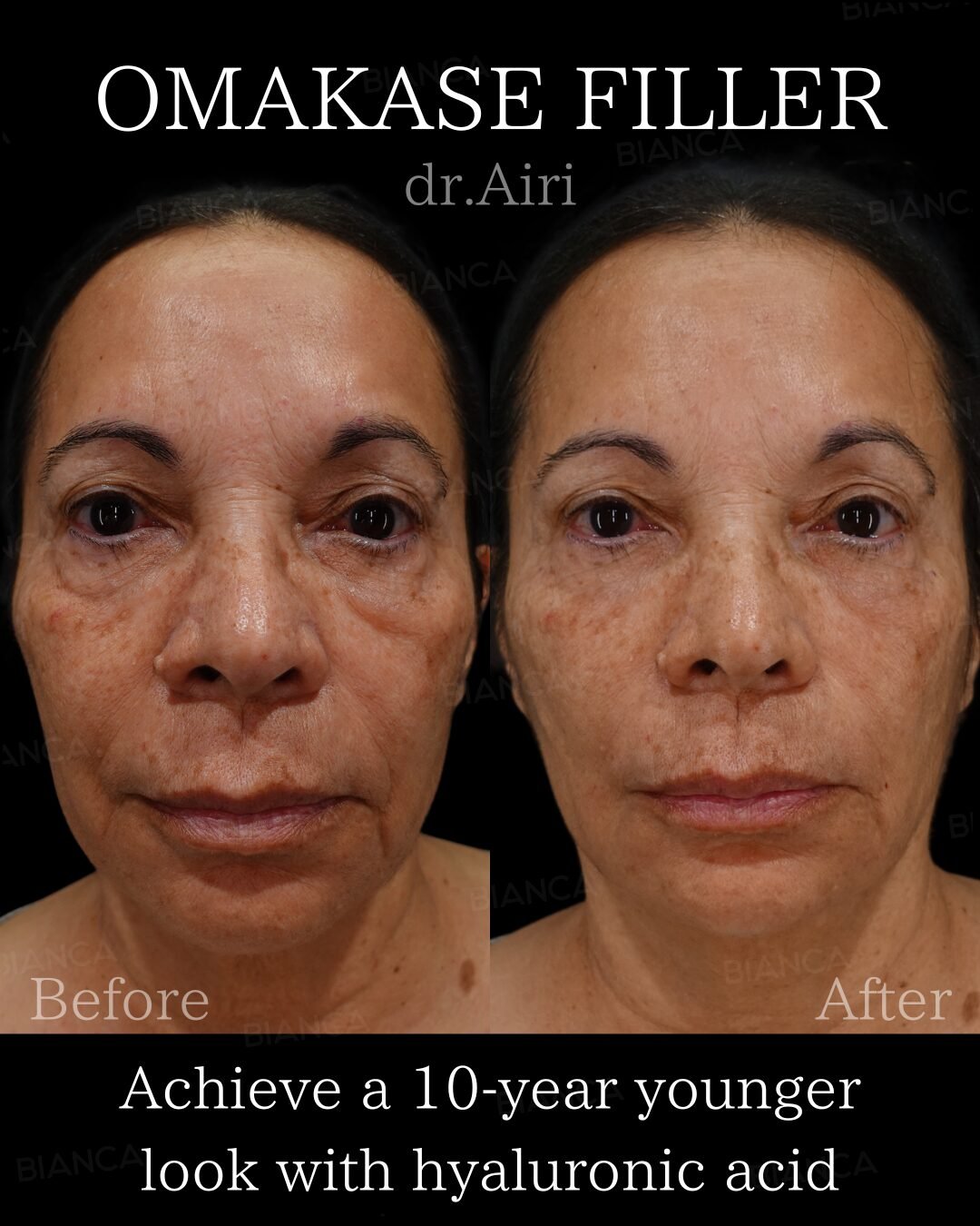 Non-Surgical Face Lift Guide: Thread Lift and Hyaluronic Acid in Tokyo, in Japan