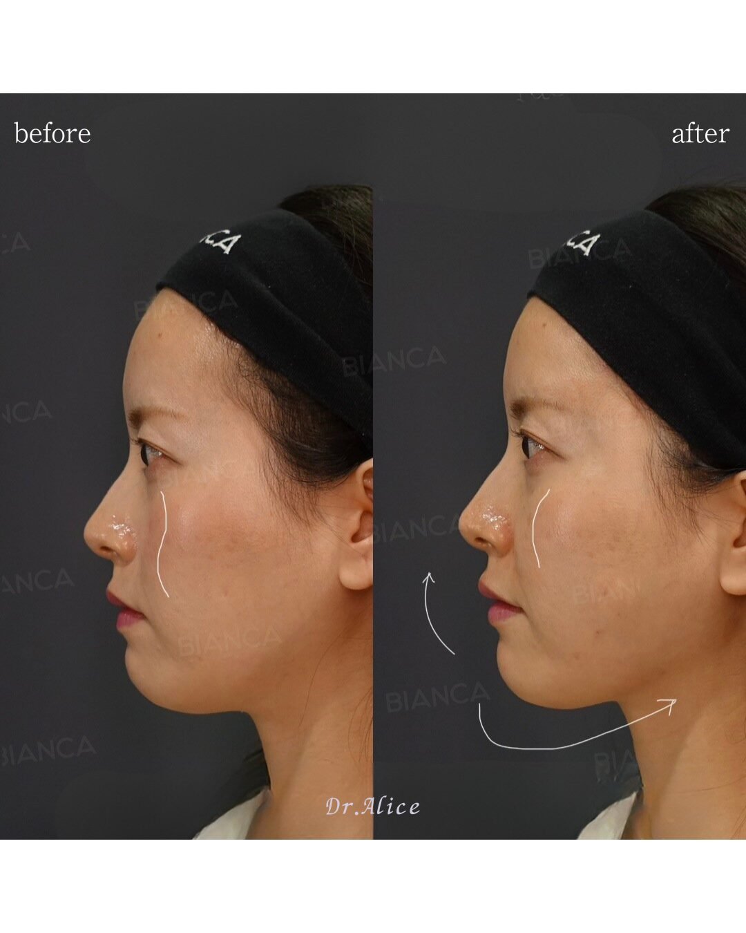 Fillers Cheeks Before and After: My Tokyo Cosmetic Surgery Journey Near Me