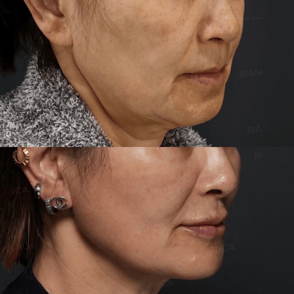 Cavitation and RF: Gentle Contouring, Tightening & English-Speaking Guidance at BIANCA CLINIC In Tokyo