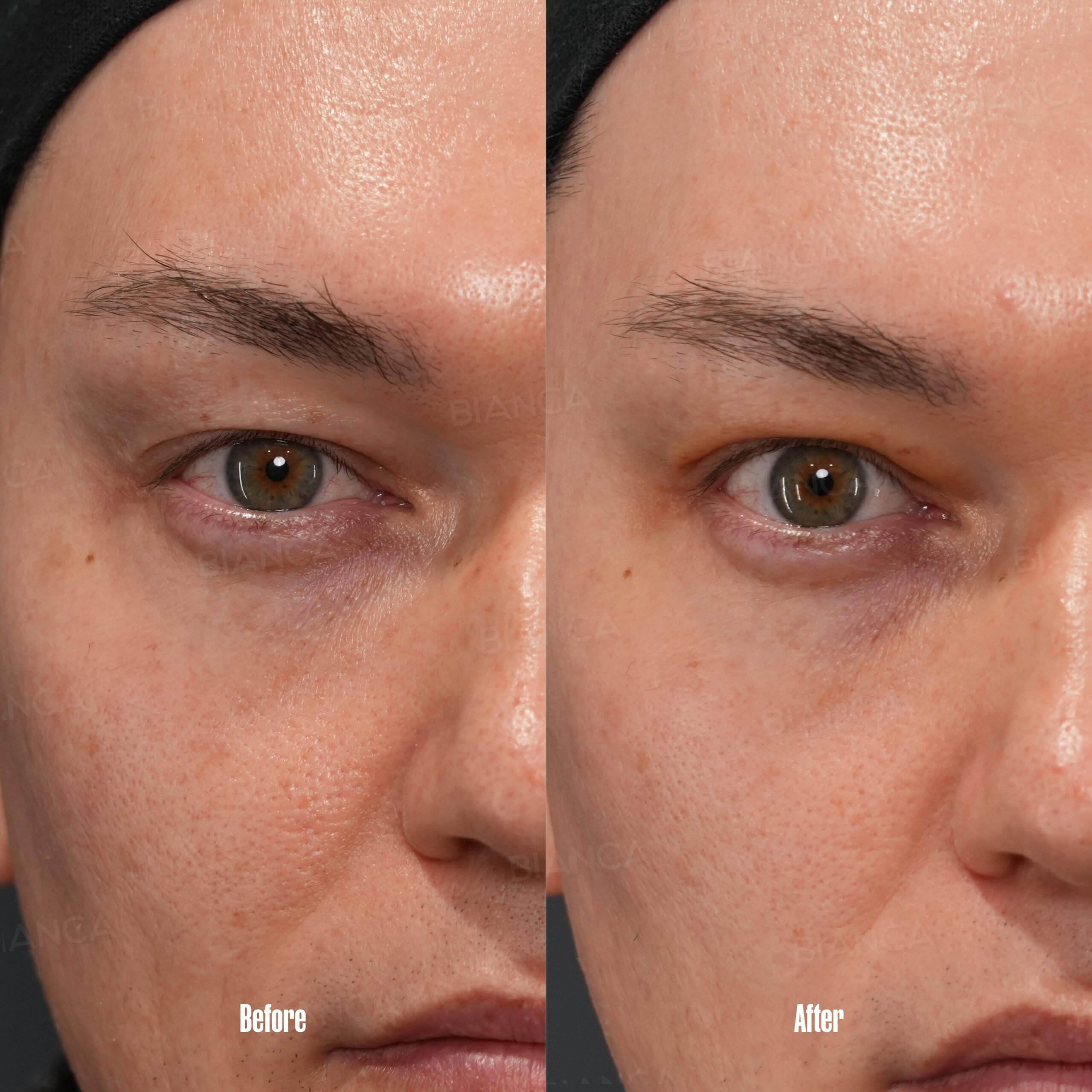 Hooded Eyes: Surgical Solutions 2.0