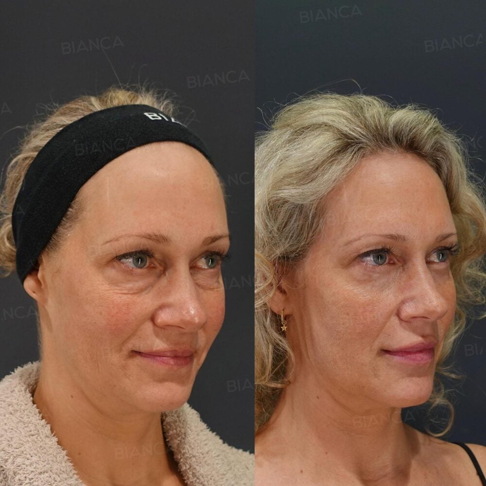 Eyebag Surgery in Tokyo: A Gentle Guide to Natural-Looking Lower Eyelid Rejuvenation