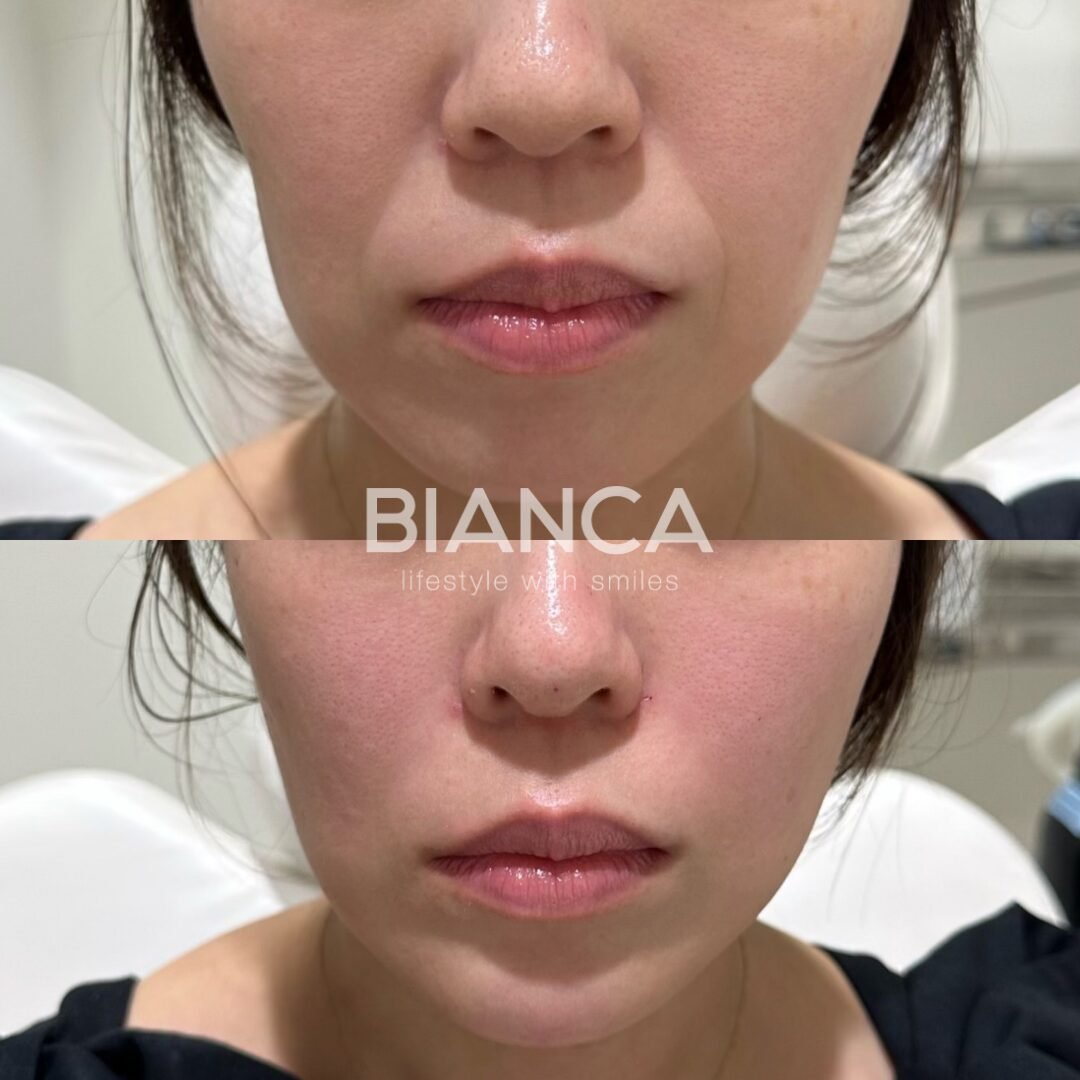 Fillers Nasolabial Folds Before and After — An Expert, Patient-Friendly Guide in Tokyo, in japan