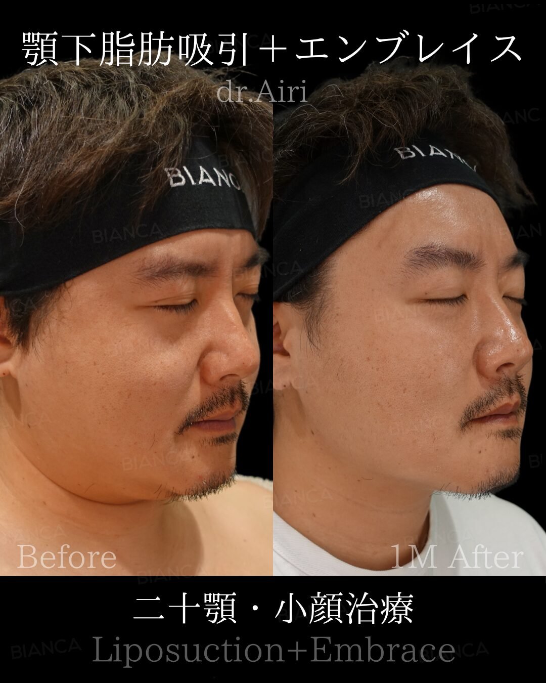 Plastic Surgery Cost in Japan: A Clear Guide to Aesthetic & Cosmetic Surgery in Tokyo