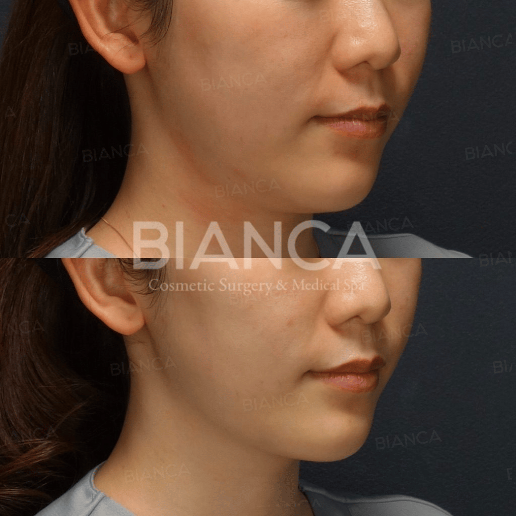 HIFU Treatment in Tokyo, in Japan: Expert, Gentle Skin Tightening at a Medical Spa Near Me