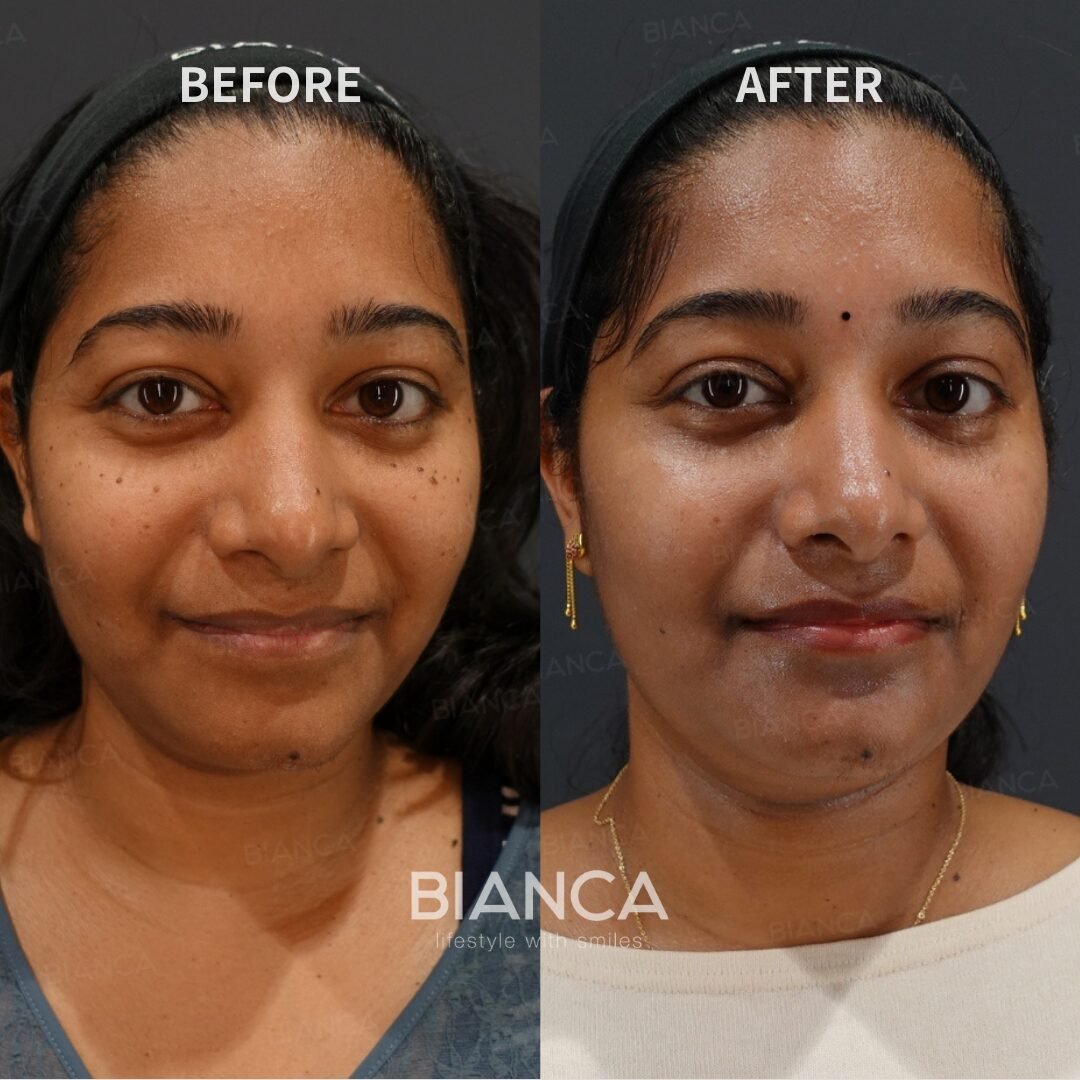 CO2 laser mole removal(unlimited)