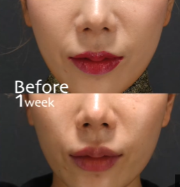 Botox on Lips (Lip Flip) in Tokyo: Safe, Subtle, and Expertly Done