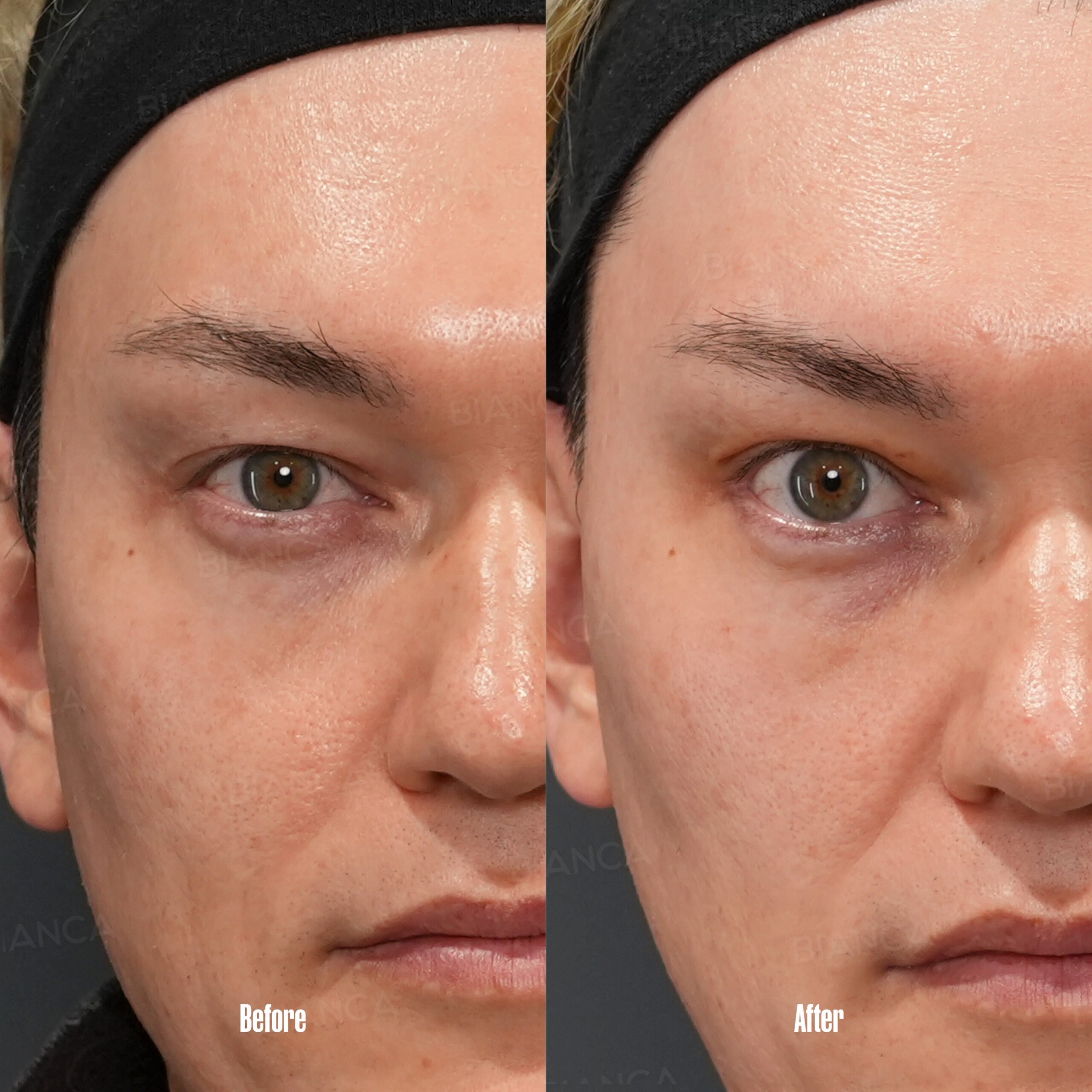 Hooded Eyes: Surgical Solutions 2.0