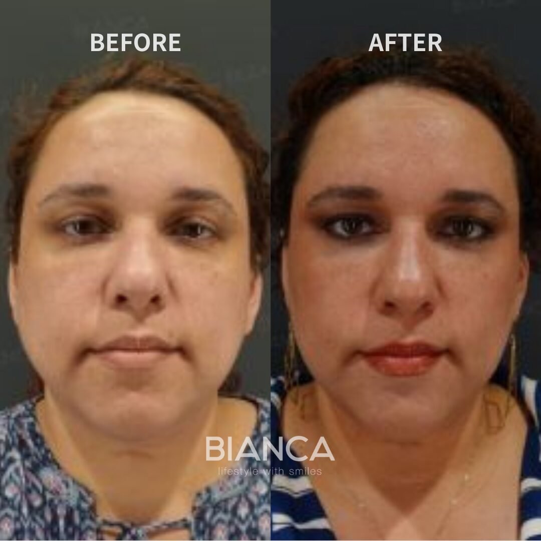 Volnuma + HIFU ( Full face / Under chin )